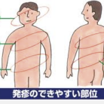 季節の変わり目に起こる「帯状疱疹」